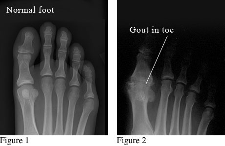 Putting Your Foot Down On Gout Gout Treatment Upmc Pinnacle