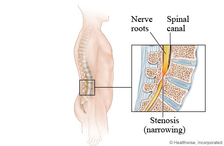 Picture of lumbar spinal stenosis