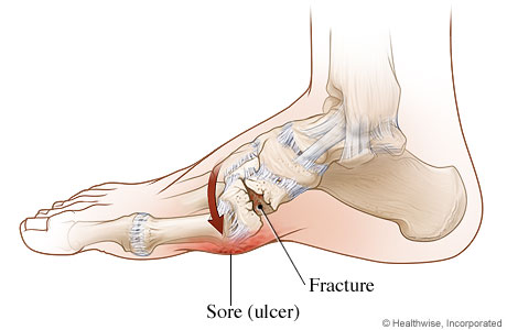 Foot bones, showing fractured bone and skin sore over broken bone.