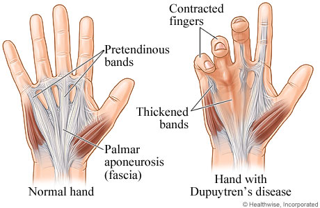 Picture of normal hand and hand with Dupuytren's disease