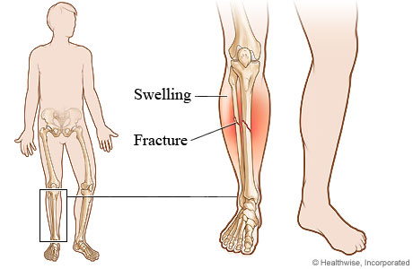 小腿骨折的图片