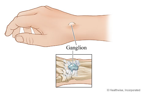 ganglion cyst diagram