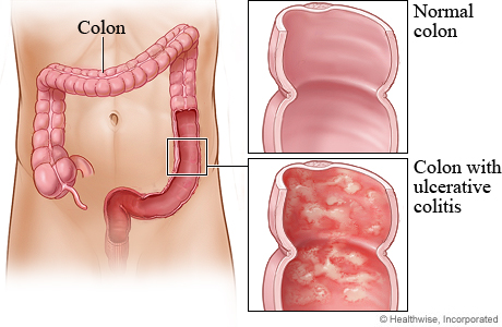 Colon with ulcerative colitis