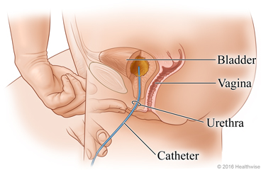 Side view of female anatomy, showing the insertion of the catheter.