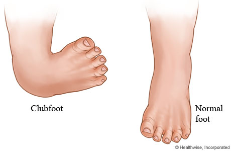 Clubfoot and normal foot
