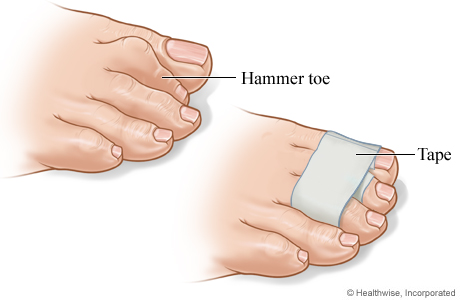 A wrapped hammer toe