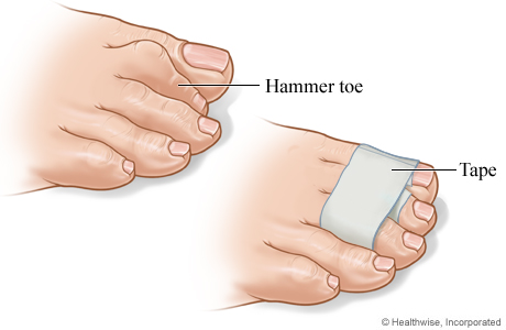 Hammer Toe Exercises