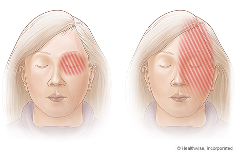 Áreas de dolor asociadas con las migrañas