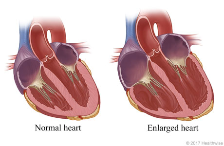 Normal heart and an enlarged (dilated) heart.