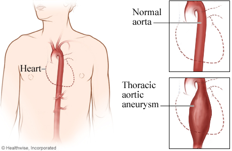 A normal aorta and a thoracic aortic aneurysm