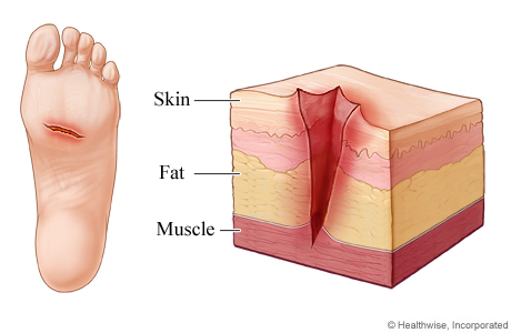 Advanced Wound Care