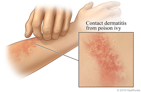 Contact dermatitis on an arm, with close-up of rash.