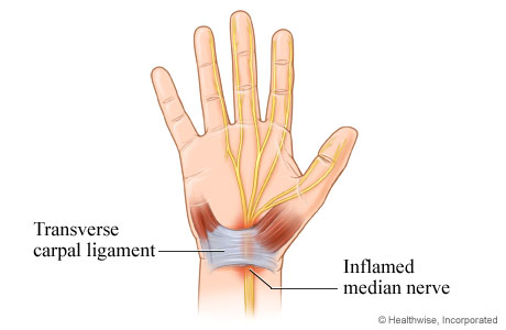 Inflamed median nerve in carpal tunnel syndrome.