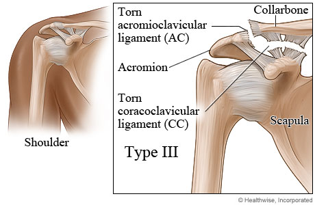 Type III shoulder separation