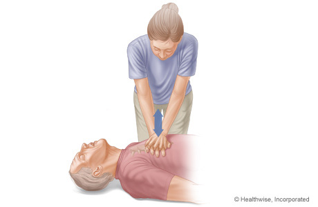 CPR on adult, showing hands stacked and laced together, giving compressions on breastbone.