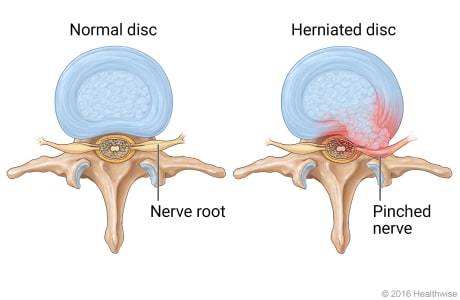 Pinched Nerve (Compression) Symptoms and Treatment | UPMC