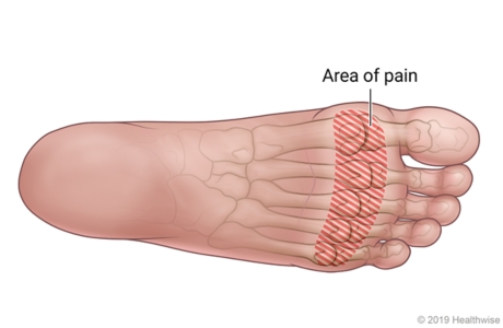 Bottom of foot, showing area of pain in metatarsalgia