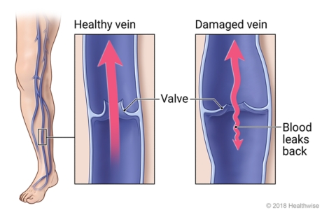 Chronic Venous Insufficiency: Causes, Symptoms and Treatment