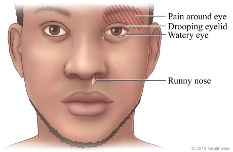 what causes cluster headaches