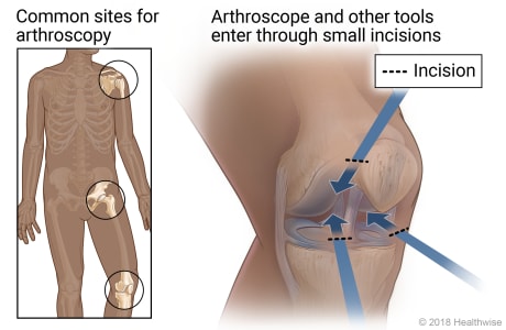 Common sites for arthroscopy, with detail of incision points in knee joint