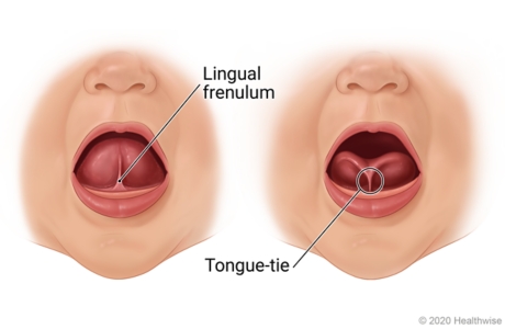 Baby's open mouth with tongue raised, showing a normal lingual frenulum and one that's too short (tongue-tie)