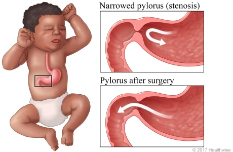 Location of pylorus in baby's abdomen, with detail of narrowed pylorus (stenosis) before and after surgery